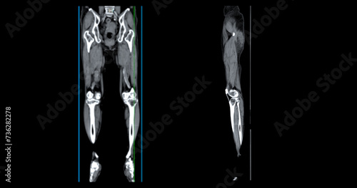 A CT venogram of the leg is a non-invasive imaging procedure offering detailed visuals of leg veins. photo