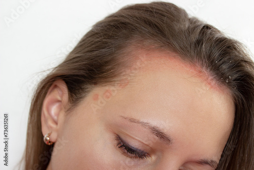 Foto Inflammation of the scalp in a young woman