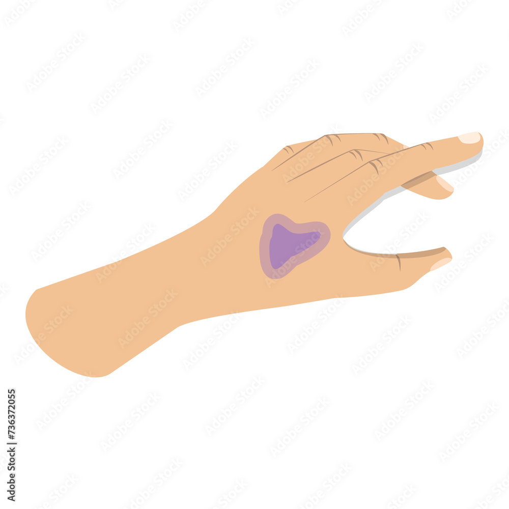 3D Isometric Flat Illustration of First Aid For Trauma. Item 6 3D Isometric Flat Illustration of First Aid For Trauma. Item 6