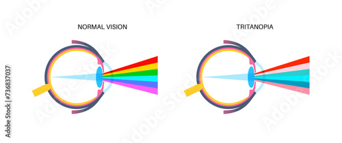Tritanopia and tritanomaly