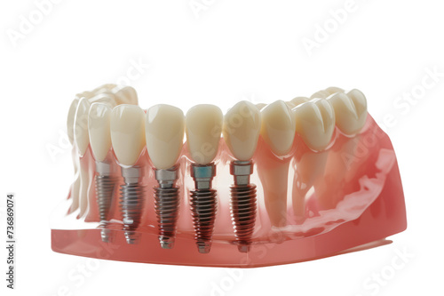 dental model featuring multiple implants, demonstrating various tooth replacement options. photo