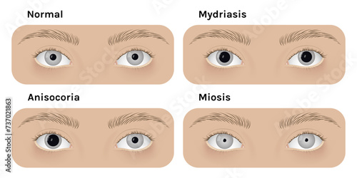 Realistic human normal eyes and with mydriasis, anisocoria, miosis