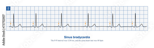 When the frequency of sinus rhythm is less than 60 beats per minute, it is called sinus bradycardia. Severe sinus bradycardia should be suspicious of sick sinus syndrome. photo