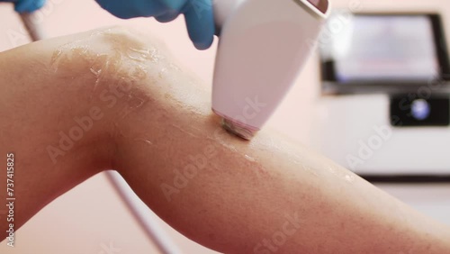 Laser hair removal on legs. Getting rid of unwanted body hair, body care, removal of unwanted hair, cosmetology. Beautiful female legs.