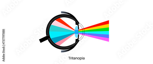 Tritanopia and tritanomaly