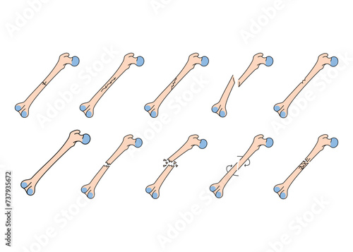 Bone fracture line icons set. Vector isolated element.
