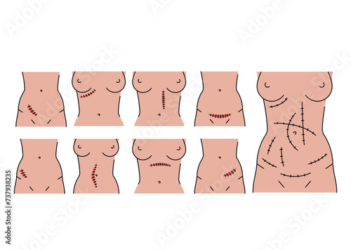 Abdominal incisions line icons set.
