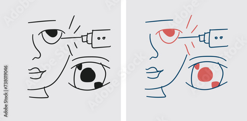 corneal edema or swelling of the cornea can occur after cataract surgery, which may affect the drainage of fluid from the eye and lead to an increase in IOP
