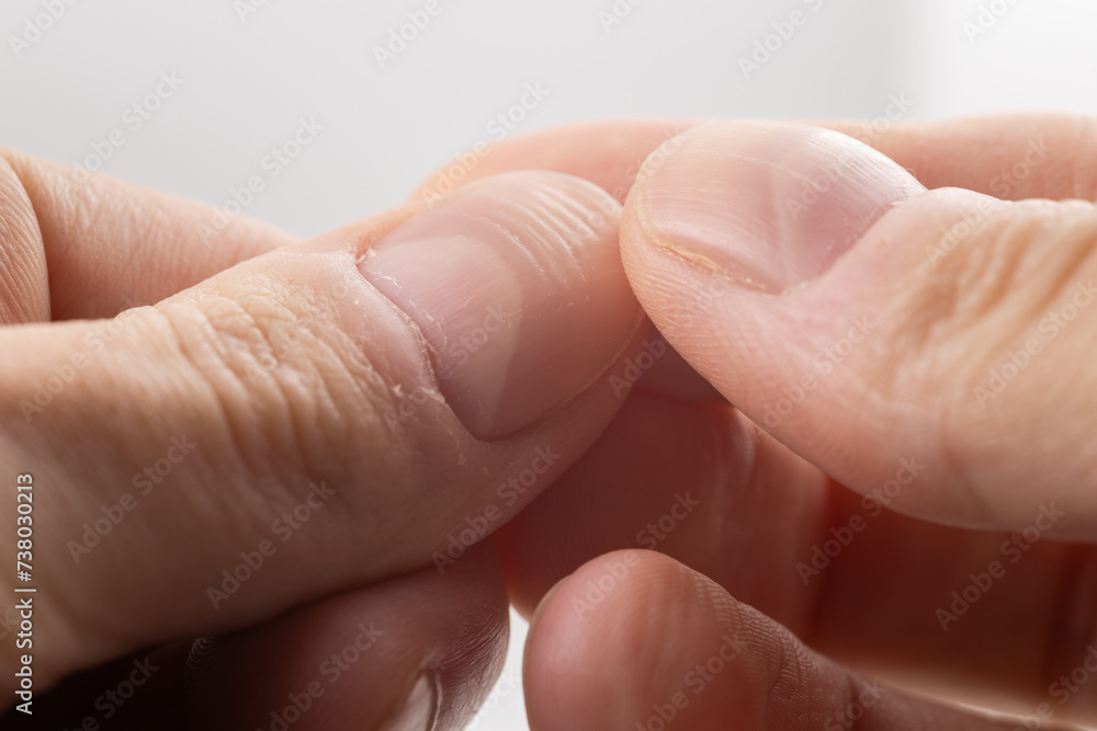 Ridged fingernails with vertical and horizontal ridges. Nails problems. Stock Photo Adobe Stock
