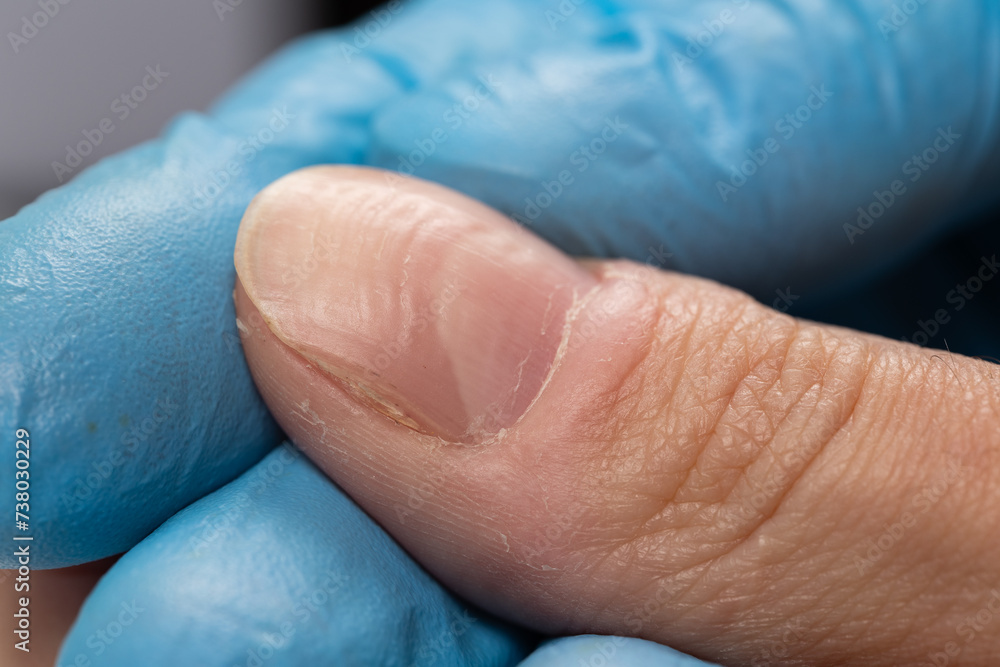 Doctor examining a ridged fingernails with vertical and horizontal ridges. Nails problems Stock