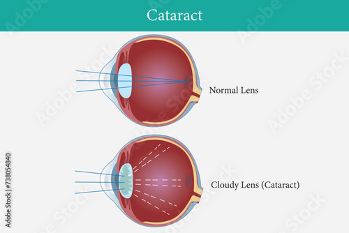 illustration of cataract in human eyes. eye vision disorder. vector illustration. eps 10