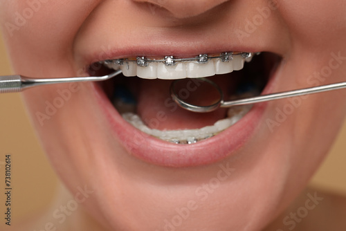 Examination of woman s teeth with braces using dental tools  closeup