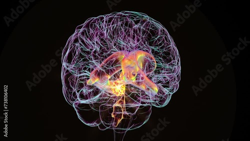 A 3D scientific animation depicting enlarged lateral and third ventricles of the brain (hydrocephalus), caused by a brain tumor compressing the cerebral aqueduct. photo