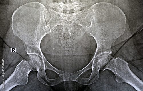 Plain X ray reveals bilateral Avascular necrosis (AVN) of the femoral head more in the left side, a type of aseptic osteonecrosis, which is caused disruption of the blood supply to the proximal femur photo