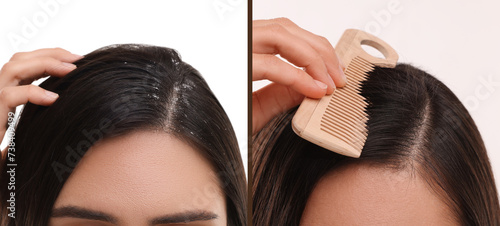 Woman showing hair before and after dandruff treatment on white background, collage