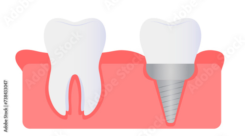 Natural and implanted teeth in gum on white background