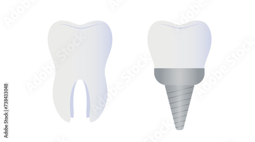 Natural and implanted teeth on white background
