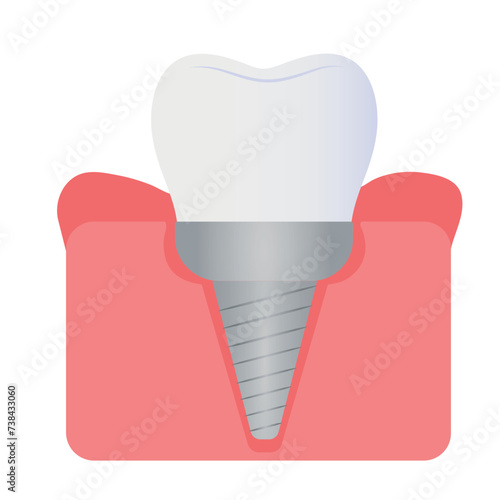 Implanted tooth in gum on white background