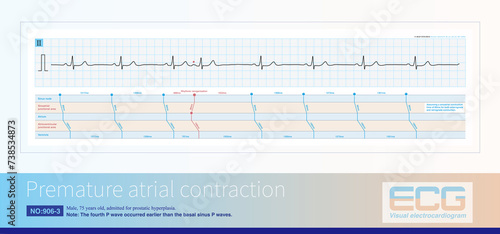 The ECG diagnosis of atrial premature contraction is an early P wave with a morphology that differs from sinus P wave and is mostly incomplete in compensatory intervals. photo