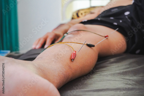 Closeup needles on patient body stimulated by electric. Acupuncture, Chinese alternative medicine.