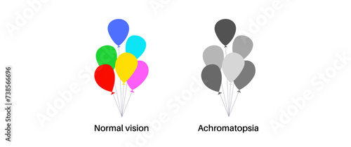 Achromatopsia vision deficiency