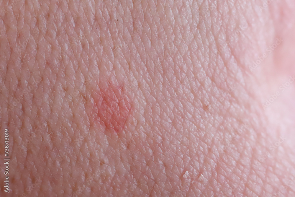 Fototapeta premium Reddened skin after being bitten by a drinking flea that feeds on human blood.