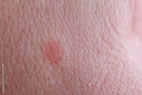 Reddened skin after being bitten by a drinking flea that feeds on human blood. photo