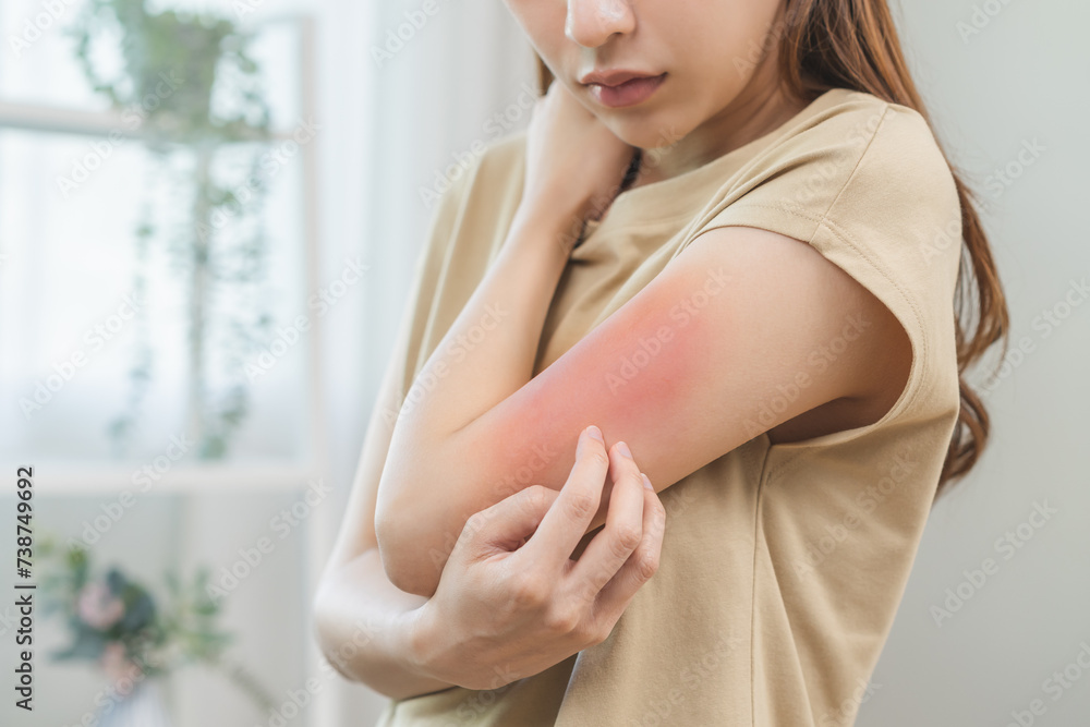 Dermatology asian young woman, girl allergy, allergic reaction from atopic, insect bites on her arm, hand in scratching itchy, itch red spot or rash of skin. Healthcare, treatment of beauty. Dermatology asian young woman, girl allergy, allergic reaction from atopic, insect bites on her arm, hand in scratching itchy, itch red spot or rash of skin. Healthcare, treatment of beauty.