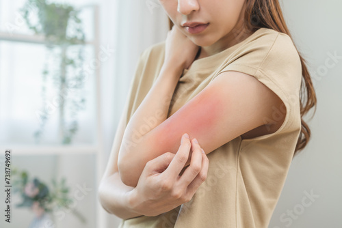 Dermatology asian young woman, girl allergy, allergic reaction from atopic, insect bites on her arm, hand in scratching itchy, itch red spot or rash of skin. Healthcare, treatment of beauty.