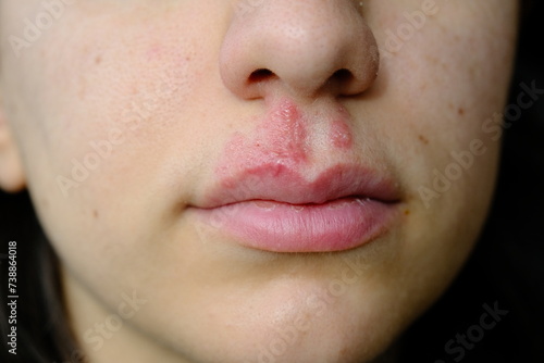 close-up of a woman with herpes on her lip: vesicle and blister