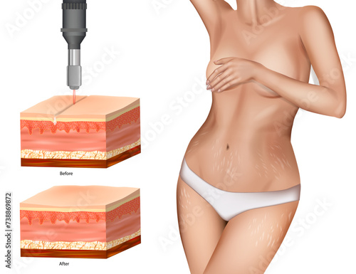 Stretch Mark Removal. Laser Treatments. Striae or striae distensae. Resurfacing, microneedling. 
