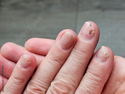 Hands and fingers with psoriatic onychodystrophy or psoriatic nails. fungal infection of nails. Deformed human nails. Damaged yellow human nail. Burn to the nail plate after a poor-quality manicure