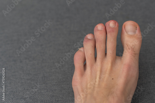 Male foot, toes, with untidy and untrimmed nails. Men's pedicure on a dark background. photo