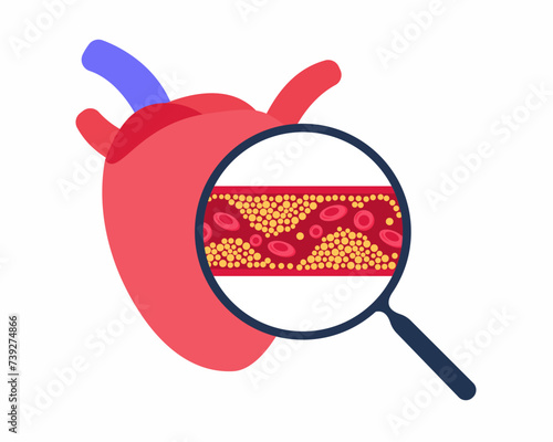 Cholesterol plaque in the blood vessels Clogged arteries caused by cholesterol vector illustration