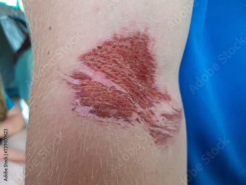 Blister Beetle rash