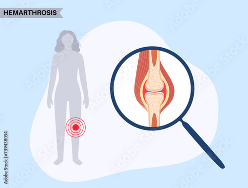 Hemarthrosis in the synovial joint photo