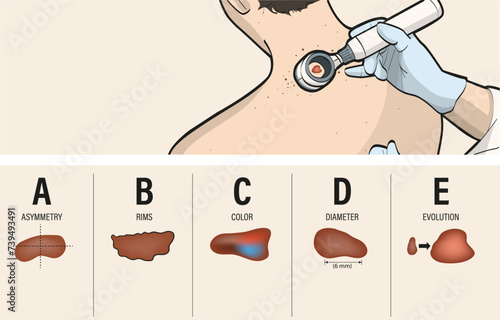Exame clínico por dermatologista. O médico realiza a dermatoscopia, aparelho que permite visualizar camadas de pele que não podem ser vistas a olho nu. A biópsia também pode ser solicitada