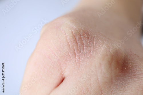 Woman with dry skin on hand against light background  closeup
