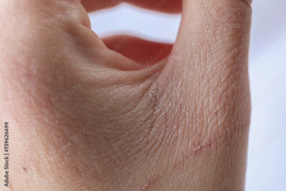 Woman with dry skin on hand against light background, closeup Woman with dry skin on hand against light background, closeup