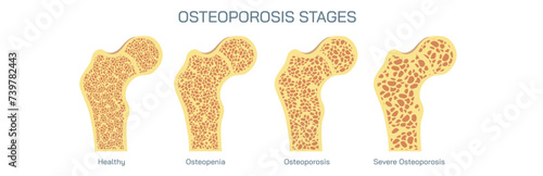 Bone density measurements and stages of osteoporosis. A bone disease that develops when bone mineral density and bone mass decreases, or the quality or structure  changes. vector illustration.