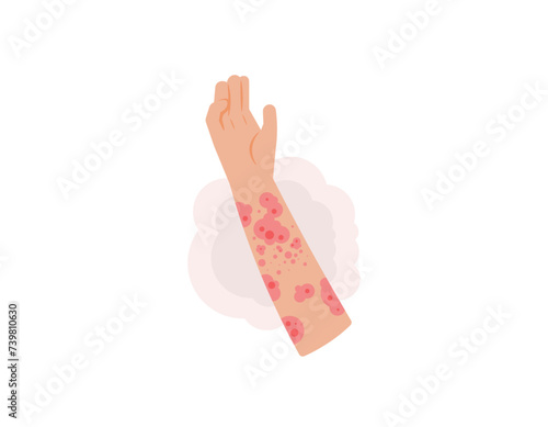 lichen planus disease. illustration of a hand with red spots on the skin. itchy skin, red rash, allergies. skin disease. health problems. cartoon or flat illustration design. graphic elements. vector