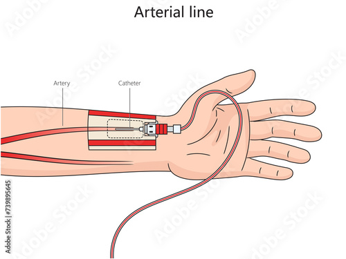 Arterial line structure thin catheter inserted into an artery diagram hand drawn schematic raster illustration. Medical science educational illustration