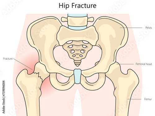 Hip fracture structure diagram hand drawn schematic raster illustration. Medical science educational illustration