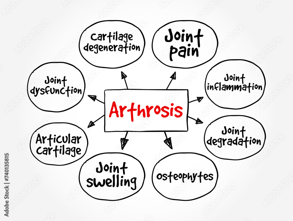 Arthrosis - most common disease of the postural and musculoskeletal system, mind map text concept background Arthrosis - most common disease of the postural and musculoskeletal system, mind map text concept background
