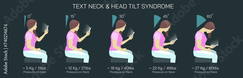 Text Neck Syndrome of phone posture is the onset of cervical spinal degeneration from excess look down at mobile screens. Aka Anterior head prevention. Cervical neck aches vector illustration. 