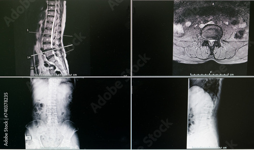 x ray image of a spine