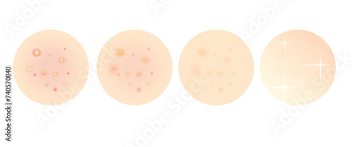 Before and after pimples, acnes isolated background, skincare problem, progress using acne cream, treatment