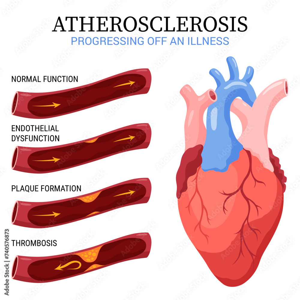 Atherosclerosis stages. Anatomy of heart attack. Arteriosclerotic ...
