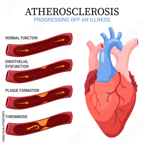 Atherosclerosis stages. Anatomy of heart attack. Arteriosclerotic vascular disease or ASVD. Atherosclerotic plaque in coronary artery. Vector illustration on white background