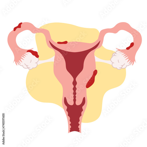 endometriosis female reproductive system ovary adhesion in flat illustration